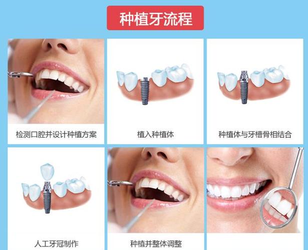 罗湖医院种一颗牙要多少钱_罗湖种牙哪里最好_深圳罗湖骨量不足全口种牙费用