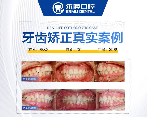 深圳宝安区矫正牙齿_深圳自锁牙套价格_深圳宝安金属自锁托槽矫正医院