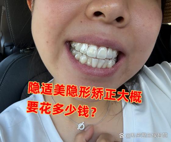 深圳隐形矫正牙齿多少钱_深圳龙岗隐适美牙套收费_深圳隐适美矫正价格