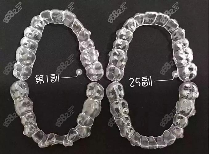 深圳隐适美矫正价格_深圳隐形矫正牙齿多少钱_深圳龙岗隐适美牙套收费