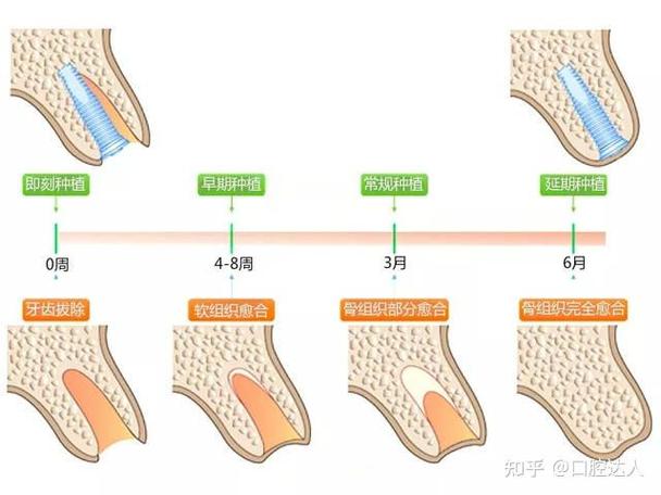 掉3颗牙怎样种植?种牙流程全解析+费用避坑指南