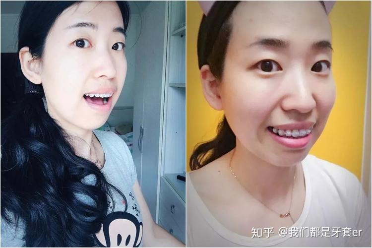 30岁做牙齿矫正晚不晚?真实情况告诉你