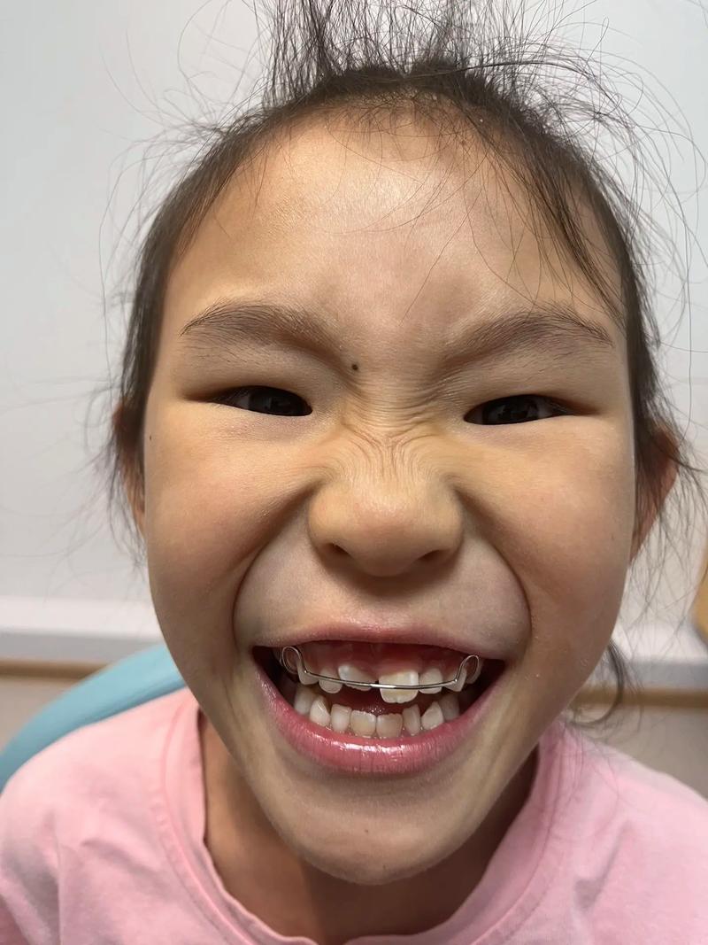 矫正牙齿18岁晚吗_牙齿矫正晚上戴头套_牙齿矫正晚上戴白天不戴