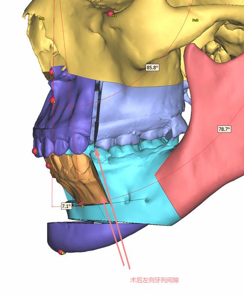 牙齿矫正颌垫的作用_牙齿矫正颌垫的图片_矫正牙齿正颌