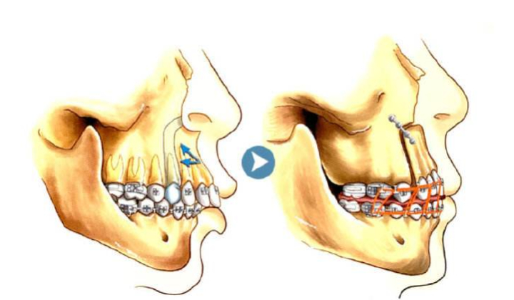 牙齿矫正颌垫的作用_牙齿矫正颌垫的图片_矫正牙齿正颌