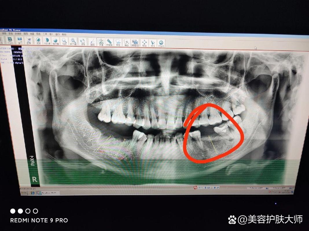 皓圣美牙科种植体价格_皓圣种植牙一般能用多少年_深圳皓圣种植牙医院推荐