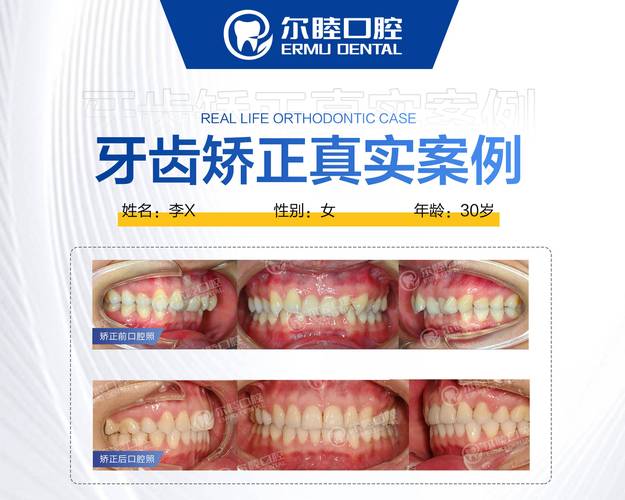 深圳牙齿矫正牙科_深圳钢牙矫正哪家牙科划算_深圳做牙齿矫正多少钱
