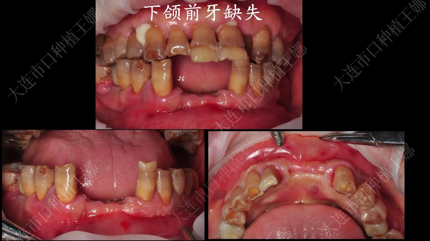 拔前牙能整好牙吗？真相与风险全解析