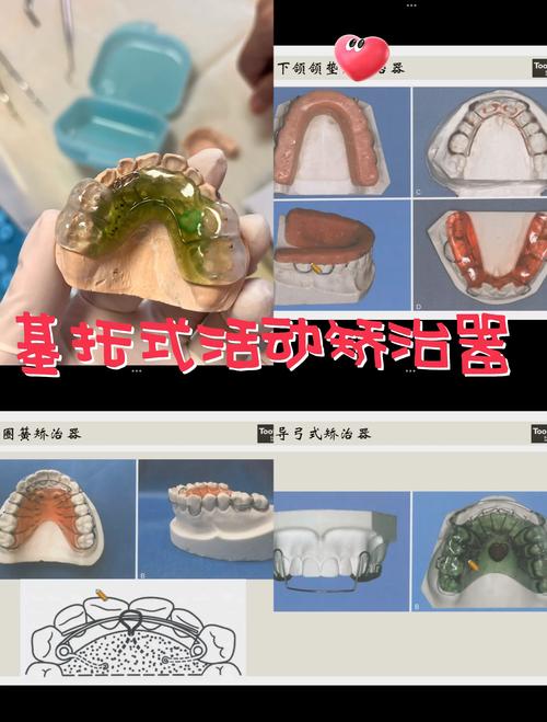 矫正定制器式正畸多少钱_定制的矫正器很贵吗_定制式正畸矫正器