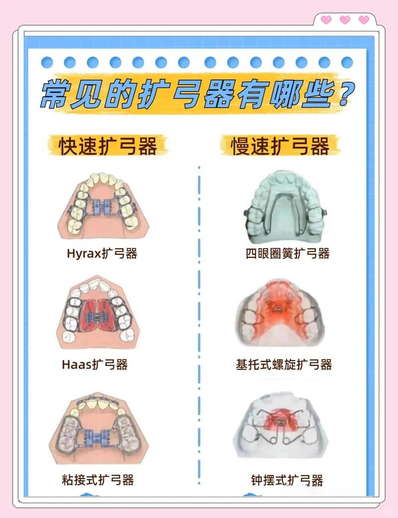 定制的矫正器很贵吗_定制式正畸矫正器_矫正定制器式正畸多少钱