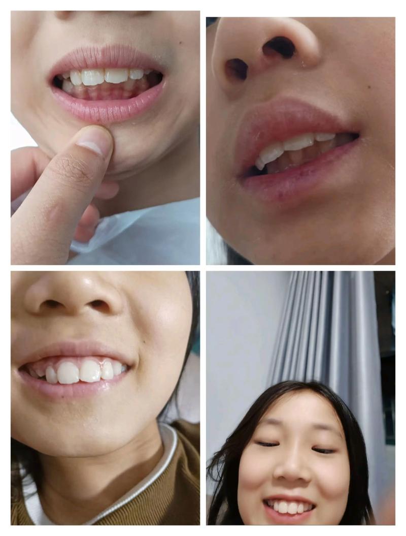 佳德口腔24岁正畸牙齿_佳德口腔牙齿矫正_牙齿正畸的口腔医院