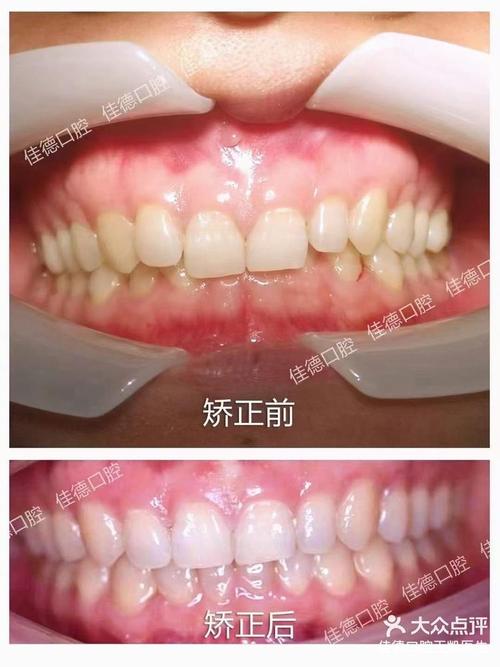 牙齿正畸的口腔医院_佳德口腔牙齿矫正_佳德口腔24岁正畸牙齿