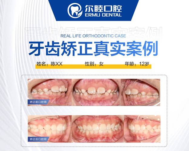牙齿矫正资费_牙齿矫正大概要花费多少钱西安_西乡牙齿矫正费用