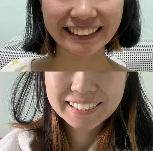 龅牙矫正可以改善凸嘴吗_35岁龅牙可以纠正吗_龅牙纠正会反弹吗