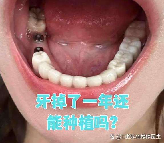 牙齿掉了还能种吗?现在种牙靠谱不靠谱