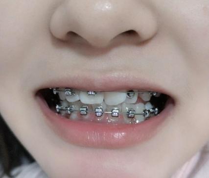 30岁做牙齿矫正有什么后遗症?看完这篇不踩坑