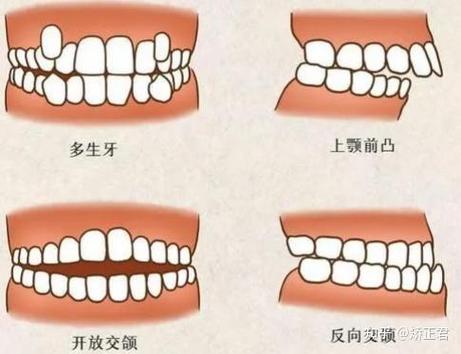 增值税缴纳逾期_30岁做牙齿矫正有什么后遗症?_mft弹簧评测