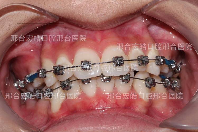 不整齐牙齿矫正到底要花多少钱？大概多久能好？