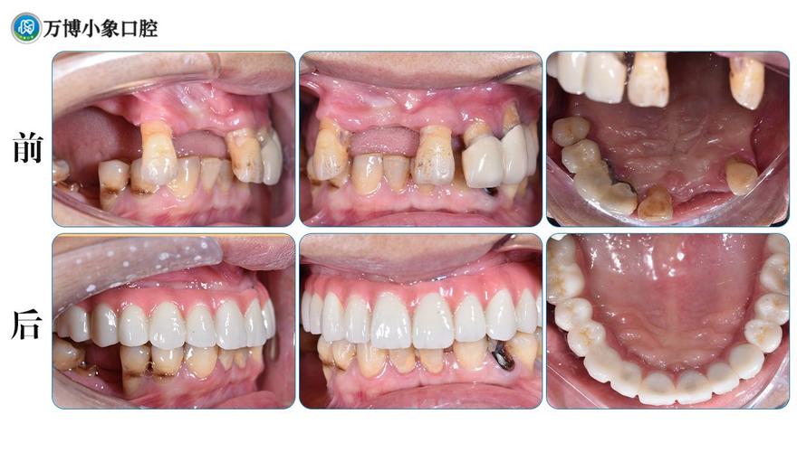 牙种植好了要注意什么_astra和nobel种植牙哪一个好?_牙种植好还是镶牙好