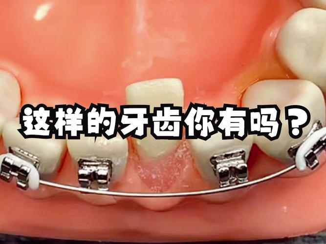 歪牙齿矫正小孩可以矫正吗_矫正牙齿孩子能忍受吗_8岁小孩的牙齿歪了可以矫正了吗