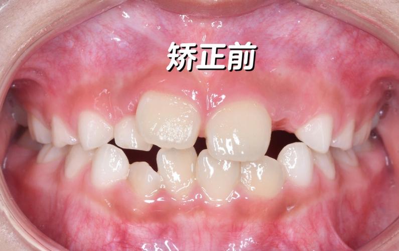 16岁孩子牙齿矫正_牙齿矫正孩子什么时候最好_牙齿矫正孩子最佳年龄