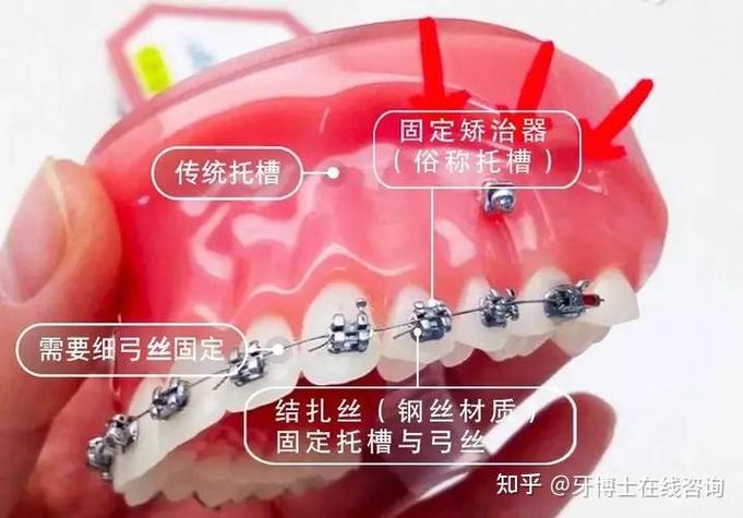 深圳龙岗隐适美牙套收费_深圳隐形牙套_深圳隐形牙套矫正价格