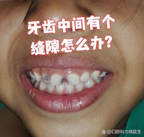 门牙有缝怎么矫正？这几种方法亲测有效