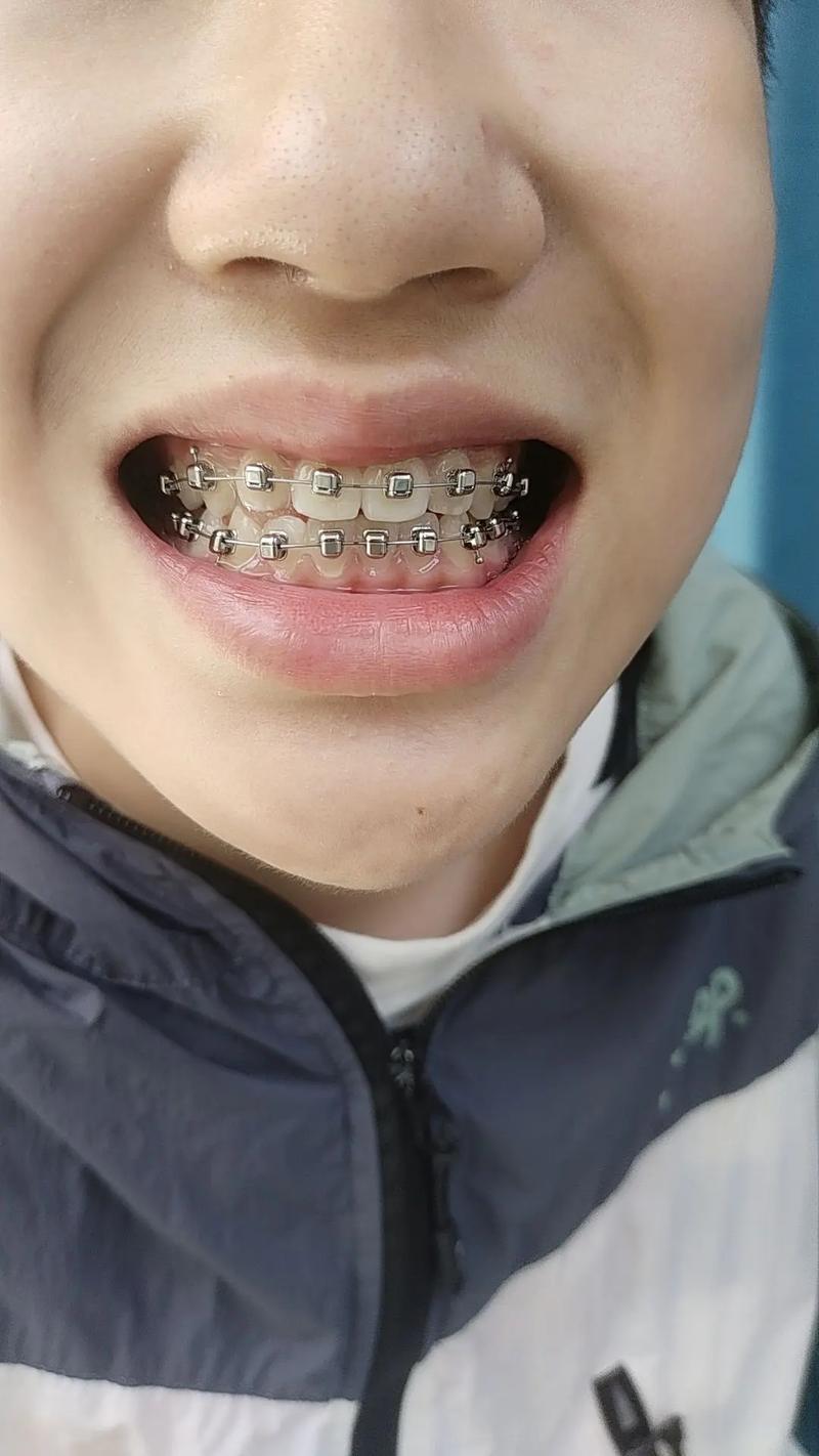 多大牙齿矫正最好_多大矫正牙齿比较好_多大年龄矫正牙齿最好