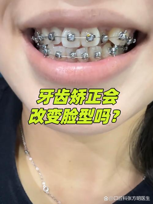 18岁龅牙能矫正吗 成人正畸看这篇就够