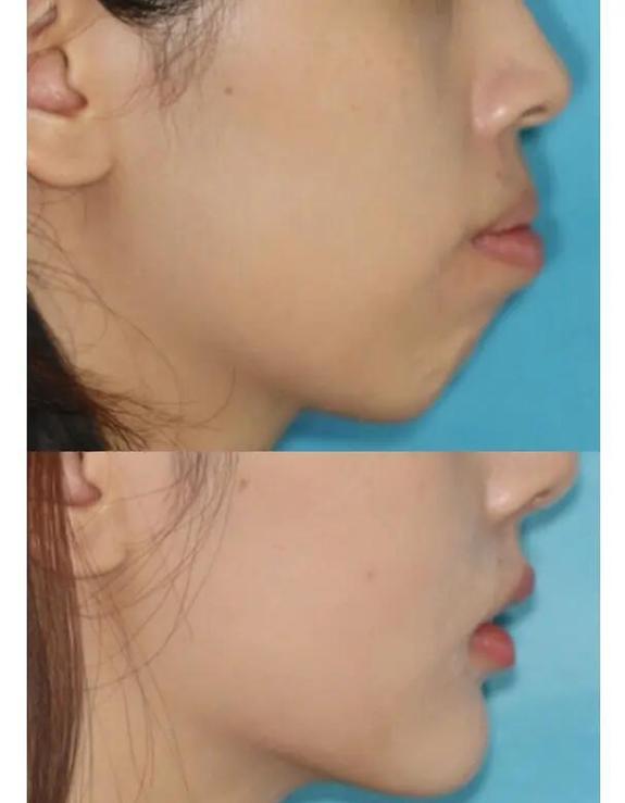 龅牙矫正完后会不会反弹_18岁龅牙可以矫正回来吗_龅牙矫正后