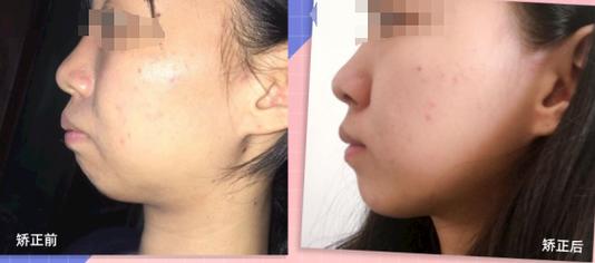 18岁龅牙可以矫正回来吗_龅牙矫正后_龅牙矫正完后会不会反弹