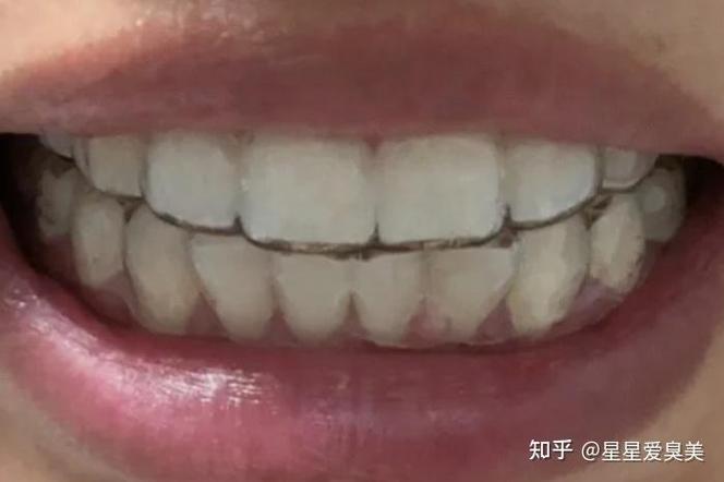 牙齿矫正能做ct吗_30多岁能做牙齿矫正吗_牙齿矫正能做一半吗