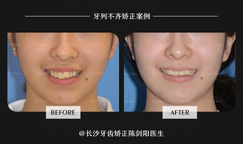 牙齿矫正拔下门牙_拔门牙矫正容易牙齿松动吗_牙齿矫正拔牙会松动吗