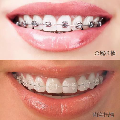 深圳深覆合牙齿矫正多少钱_牙齿覆合矫正多少钱_深覆合整牙价格