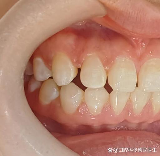 牙齿矫正牙缝大价目表_深圳牙缝过大矫正报价_矫正报价深圳牙缝过大的医院
