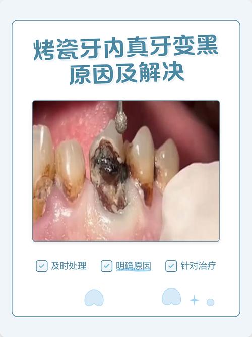 一个牙医的良心忠告烤瓷牙_牙科诊所烤瓷牙一般多少钱_良心医生建议做烤瓷牙