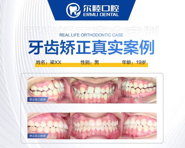 南京儿童牙齿正畸费用_九院正颌正畸费用_深圳福田青少年钢丝正畸费用