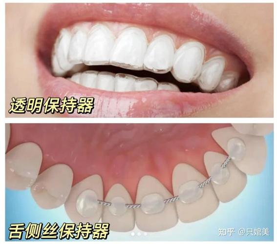 南京儿童牙齿正畸费用_九院正颌正畸费用_深圳福田青少年钢丝正畸费用
