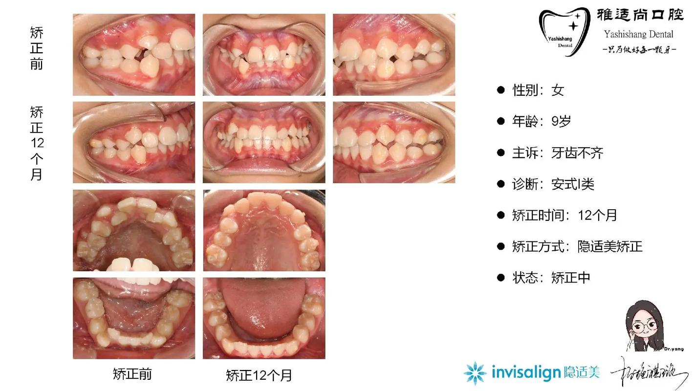 深圳隐适美矫正大概多少钱_深圳隐适美价格_深圳隐适美隐形矫正价格明细