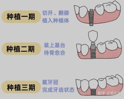 杭州种植牙骨粉贵不贵?要补多少?