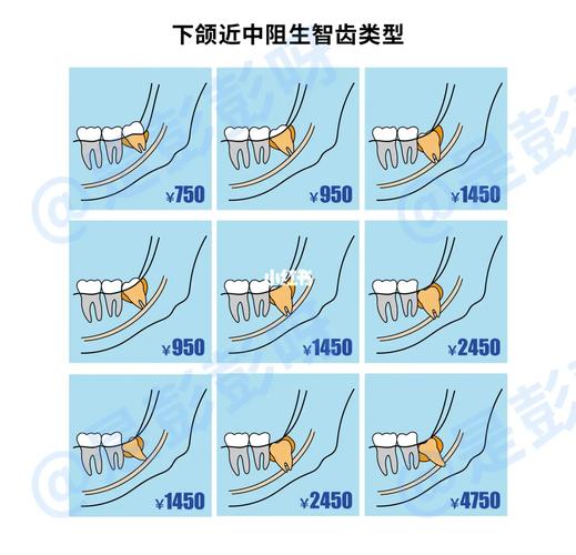 杭州口腔医院拔牙要花多少钱?怎么选才不踩坑?