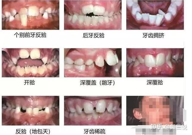 青岛儿童几岁做正畸最好?多少钱?