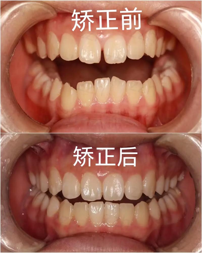 成人矫正牙齿的利与弊知乎_成人矫正牙齿有效果吗_成人矫正龅牙哪里较好