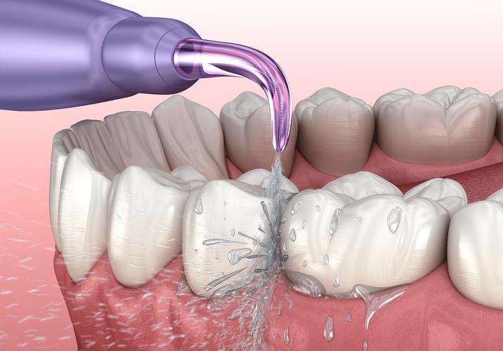 超声波洗牙全过程揭秘:从检查到抛光,一次说清疼不疼、怎么洗