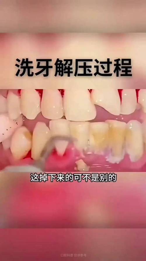 声波洗牙器有用吗_洗牙的超声波有辐射吗_超声波洗牙怎么洗