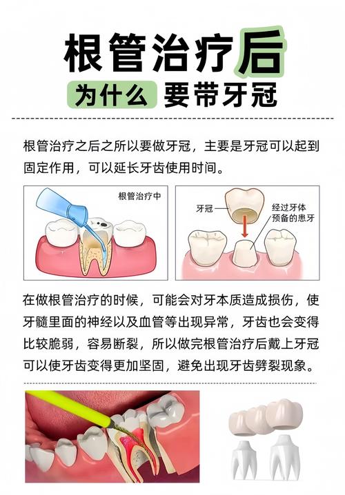 根管治疗补牙到底怎么回事?医生详解步骤和必要性