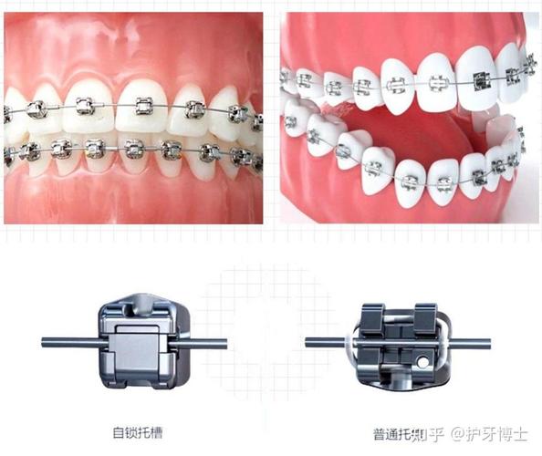 牙齿矫正是不是要很多钱_14岁牙齿矫正一般需要多少钱_牙齿矫正钱一般需要多长时间