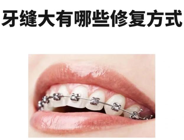成人牙齿矫正收缝要多久_深圳成人牙齿矫正哪家医院好_深圳成年人牙缝大矫正方案