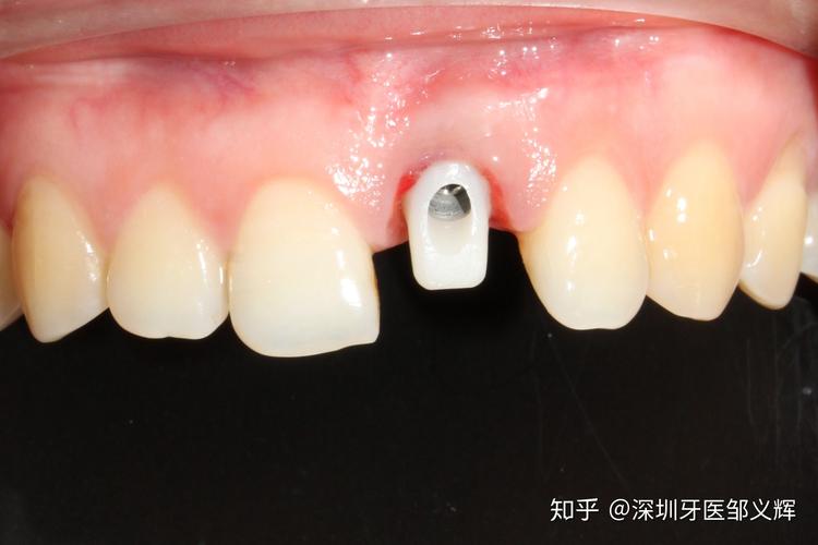 大牙能即拔即种吗_拔牙可以即拔即种吗_牙齿即拔即种多久可带牙冠
