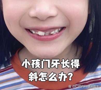 深圳换牙期牙齿错位干预_深圳换牙期牙齿错位干预_深圳换牙期牙齿错位干预
